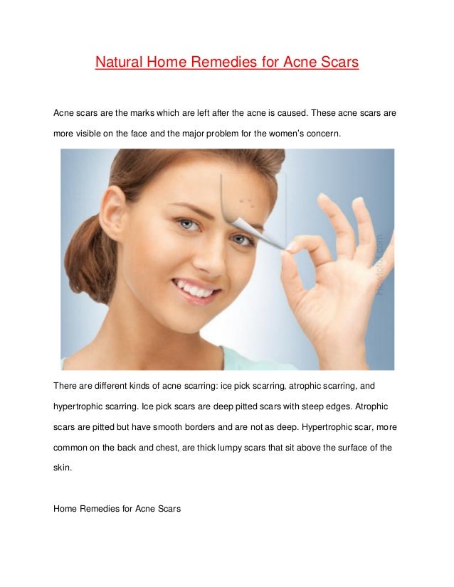 Home remedies for acne - Natural acne treatment