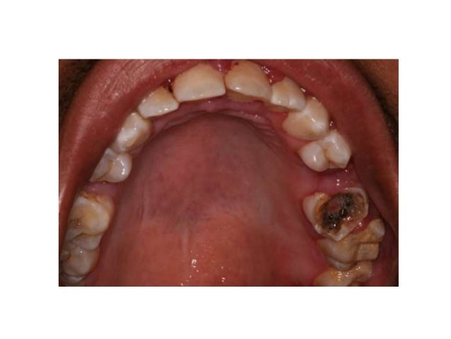 Home remedies for a toothache, wisdom teeth coming through, wisdom