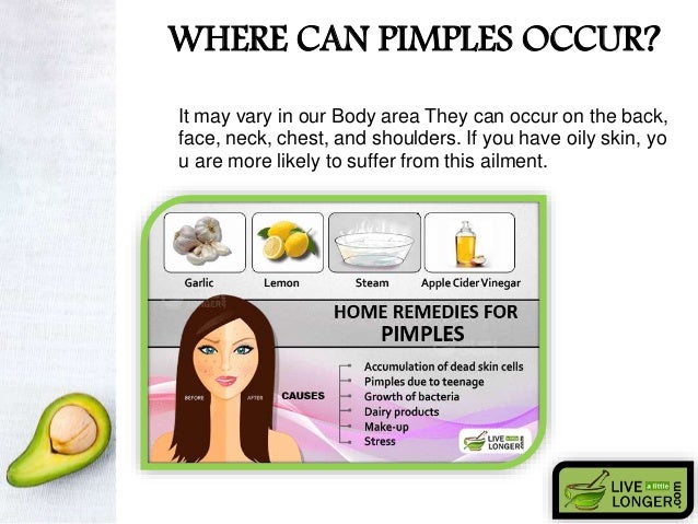 Home Remedies For Pimples N Oily Skin Home Remedies For Pimples N Oily Skin