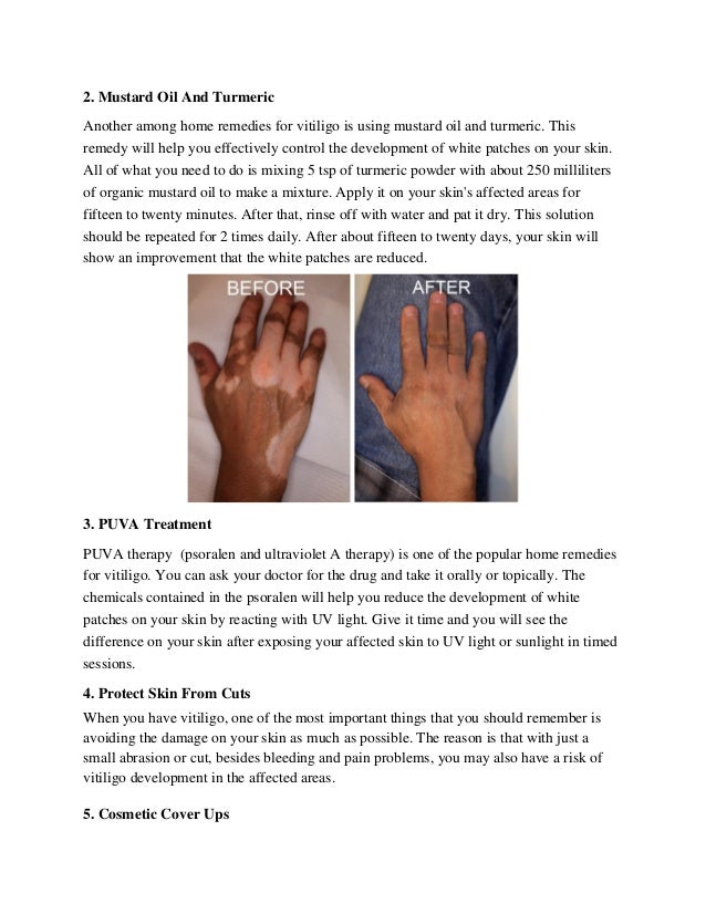 home remedies for vitiligo spots