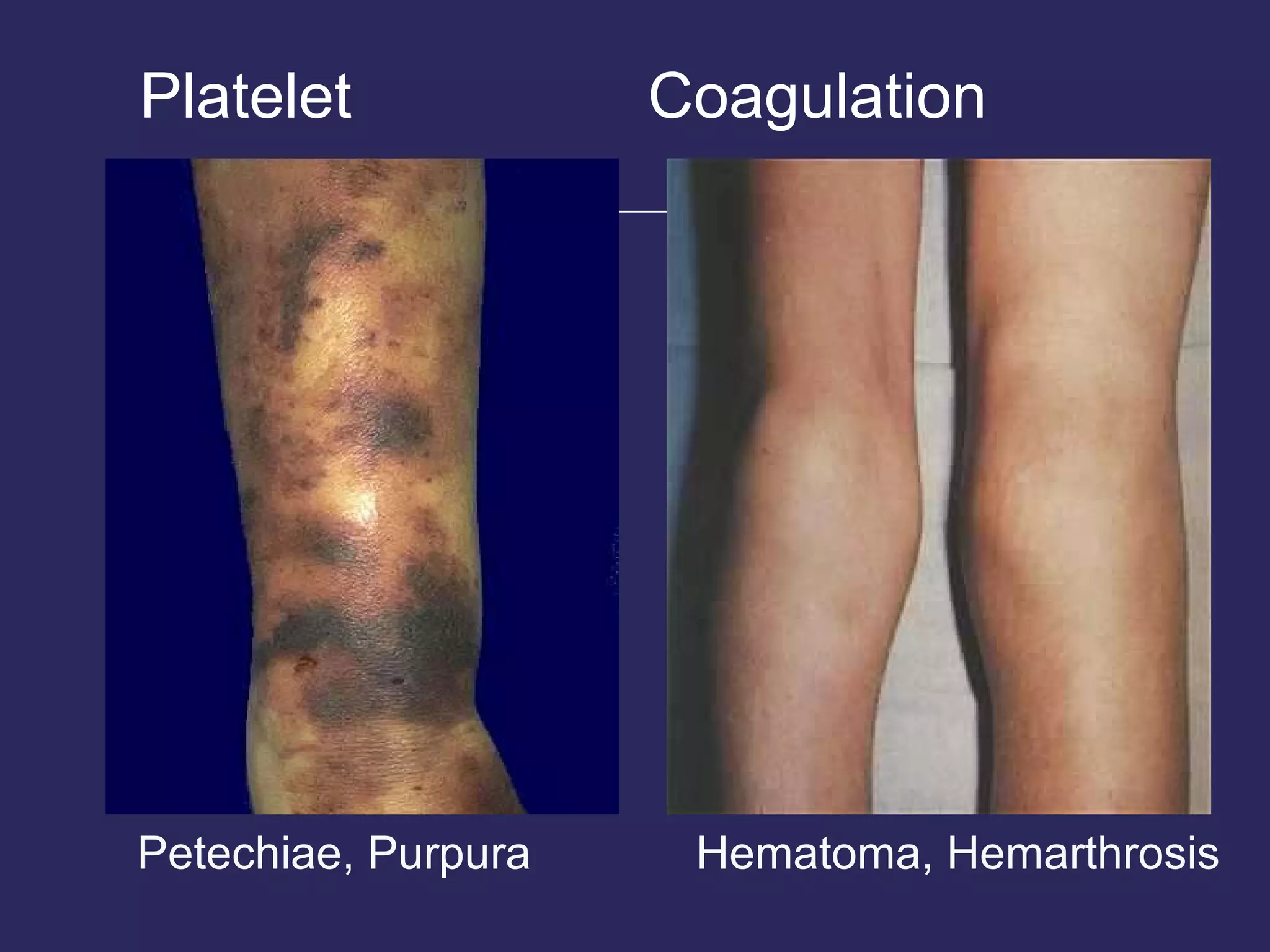 Platelet Coagulation Petechiae, Purpura   Hematoma, Hemarthrosis 