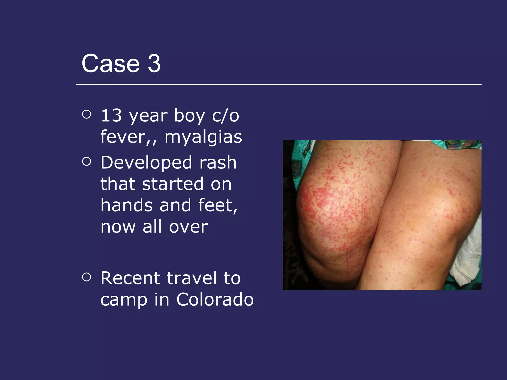 Case 3  13 year boy c/o fever,, myalgias Developed rash that started on hands and feet, now all over Recent travel to camp in Colorado 