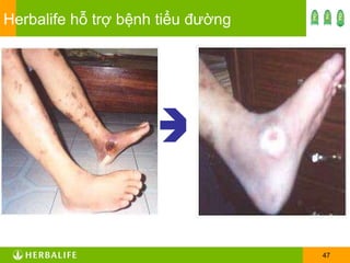 Herbalife hỗ trợ bệnh tiểu đường  