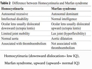 Homocytinuria (downward dislocation= low IQ),
Marfan syndrome, upward (upward= normal IQ)
 