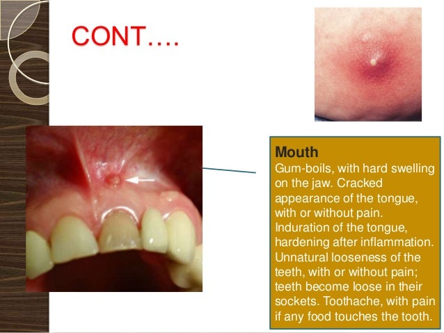 Jaw Pain After Eating Hard Food Jaw Pain After Eating Hard Food
