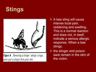 Stings A bee sting will cause intense local pain, reddening and swelling. This is a normal reaction and does not, in itself, indicate a serious allergic response. When a bee stings,  the stinger and poison sack remain in the skin of the victim.  