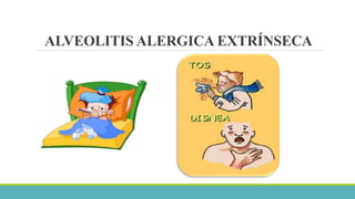 ALVEOLITIS ALERGICA EXTRÍNSECA 
 