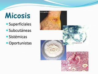 Micosis
 Superficiales
 Subcutáneas
 Sistémicas
 Oportunistas
 