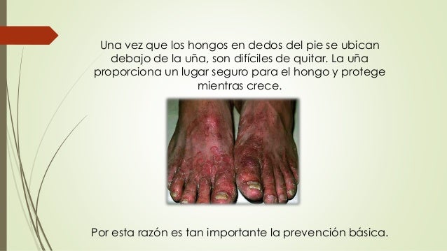 Que tratar el calzado del hongo de las uñas