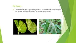 Pústulas
 Levantamiento de la epidermis y/o de la cutícula debido al crecimiento de
estructuras del patógeno en los tejidos del hospedante.
 