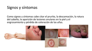 Signos y síntomas
Como signos y síntomas cabe citar el prurito, la descamación, la rotura
del cabello, la aparición de lesiones anulares en la piel y el
engrosamiento y pérdida de coloración de las uñas.
 