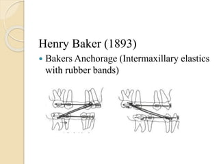 Henry Baker (1893)
 Bakers Anchorage (Intermaxillary elastics
with rubber bands)
 