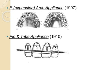  E (expansion) Arch Appliance (1907)
 Pin & Tube Appliance (1910)
 