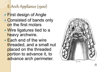 E-Arch Appliance (1900)
 First design of Angle
 Consisted of bands only
on the first molars
 Wire ligatures tied to a
heavy archwire.
 Each end of the wire
threaded, and a small nut
placed on the threaded
portion to advance it, to
advance arch perimeter.
 