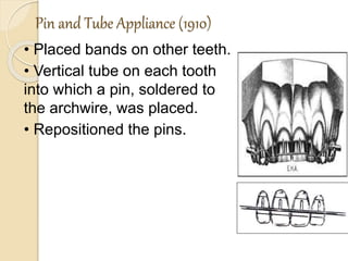 Pin and Tube Appliance (1910)
• Placed bands on other teeth.
• Vertical tube on each tooth
into which a pin, soldered to
the archwire, was placed.
• Repositioned the pins.
 
