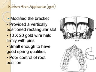 Ribbon Arch Appliance (1916)
 Modified the bracket
• Provided a vertically
positioned rectangular slot
• 10 X 20 gold wire held
firmly with pins
• Small enough to have
good spring qualities
• Poor control of root
position
 