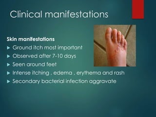 Clinical manifestations
Skin manifestations
 Ground itch most important
 Observed after 7-10 days
 Seen around feet
 Intense itching , edema , erythema and rash
 Secondary bacterial infection aggravate
 