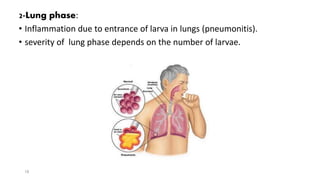 2-Lung phase:
• Inflammation due to entrance of larva in lungs (pneumonitis).
• severity of lung phase depends on the number of larvae.
18
 