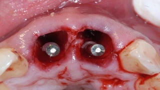 horizontal fracture .pdf