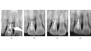 horizontal fracture .pdf
