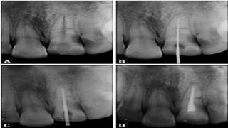 horizontal fracture .pdf