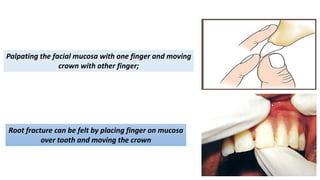 Palpating the facial mucosa with one finger and moving
crown with other finger;
Root fracture can be felt by placing finger on mucosa
over tooth and moving the crown
 