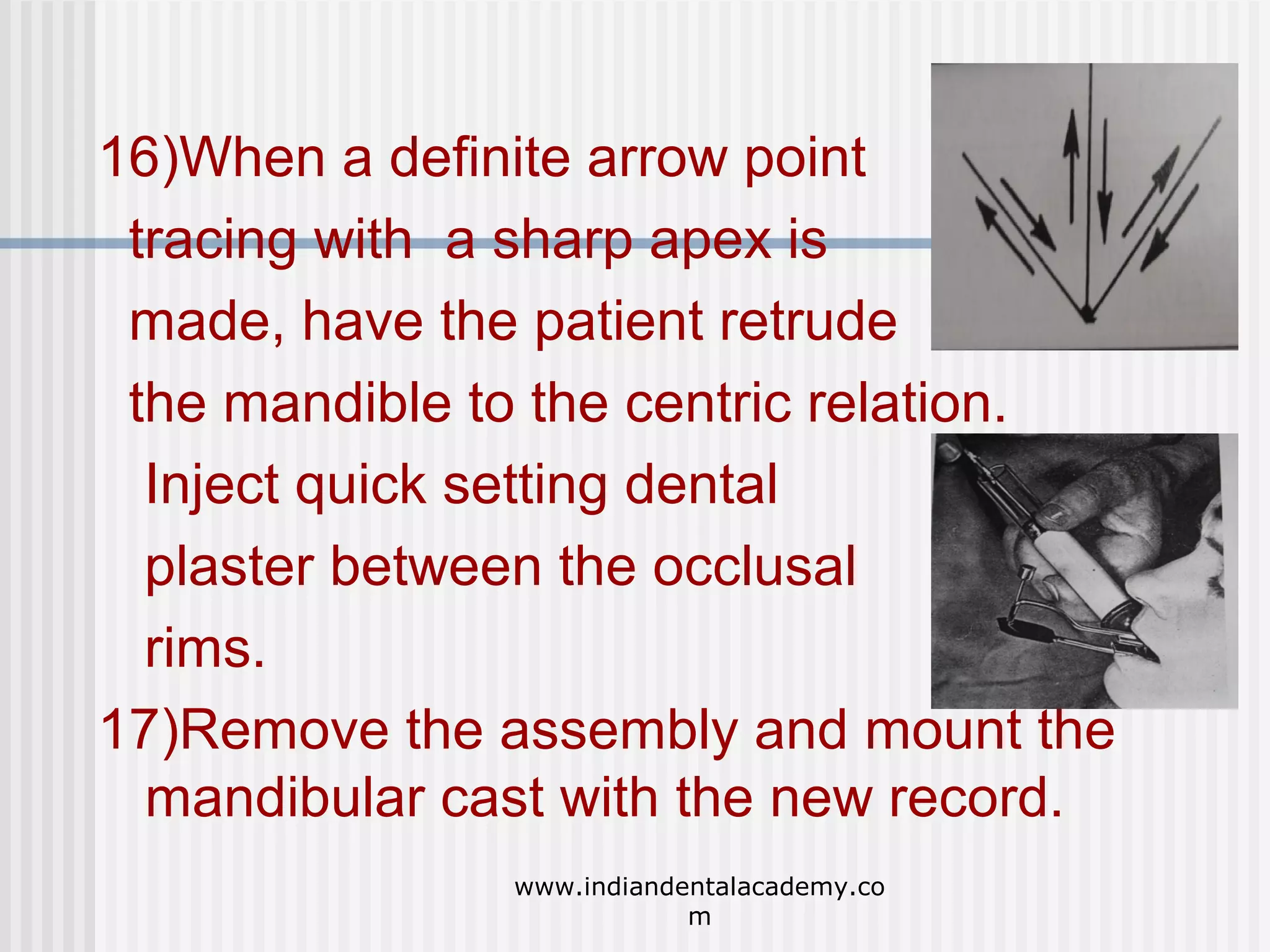 16)When a definite arrow point
tracing with a sharp apex is
made, have the patient retrude
the mandible to the centric relation.
Inject quick setting dental
plaster between the occlusal
rims.
17)Remove the assembly and mount the
mandibular cast with the new record.
www.indiandentalacademy.co
m

 