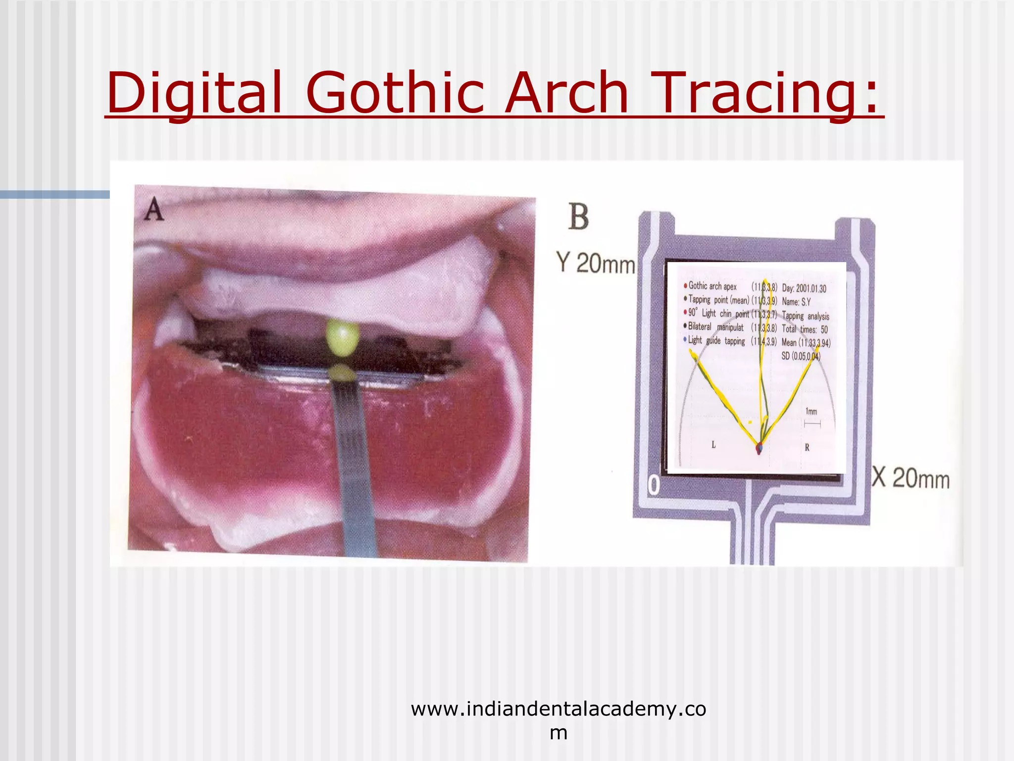 Digital Gothic Arch Tracing:

www.indiandentalacademy.co
m

 