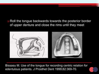  Roll the tongue backwards towards the posterior border
of upper denture and close the rims until they meet
Bissasu M. Use of the tongue for recording centric relation for
edentulous patients. J Prosthet Dent 1999;82:369-70.
 