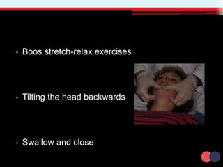 • Boos stretch-relax exercises
• Tilting the head backwards
• Swallow and close
 
