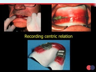 Recording centric relation
 