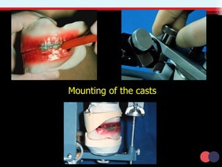 Mounting of the casts
 