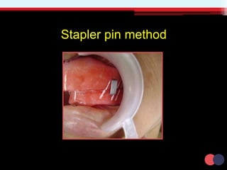 Stapler pin method
 
