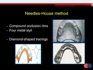 Needles-House method
• Compound occlusion rims
• Four metal styli
• Diamond-shaped tracings
 