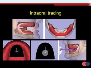 Intraoral tracing
 
