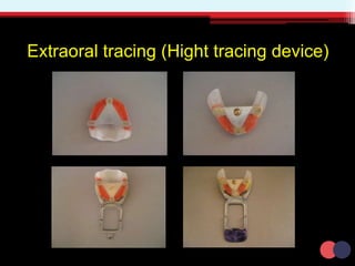 Extraoral tracing (Hight tracing device)
 