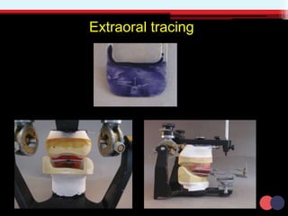 Extraoral tracing
 