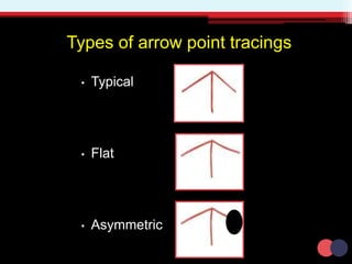 Types of arrow point tracings
• Typical
• Flat
• Asymmetric
 