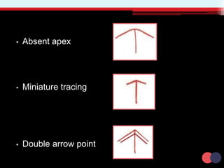 • Absent apex
• Miniature tracing
• Double arrow point
 