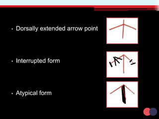 • Dorsally extended arrow point
• Interrupted form
• Atypical form
 