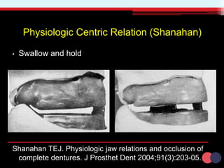 Physiologic Centric Relation (Shanahan)
• Swallow and hold
Shanahan TEJ. Physiologic jaw relations and occlusion of
complete dentures. J Prosthet Dent 2004;91(3):203-05.
 