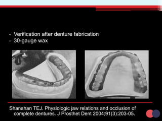 • Verification after denture fabrication
• 30-gauge wax
Shanahan TEJ. Physiologic jaw relations and occlusion of
complete dentures. J Prosthet Dent 2004;91(3):203-05.
 