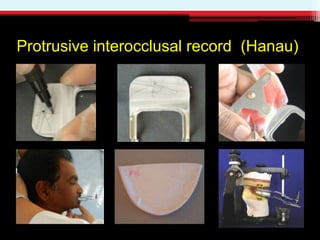 Protrusive interocclusal record (Hanau)
 