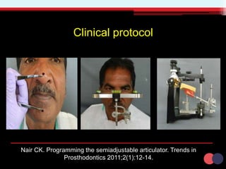 Clinical protocol
Nair CK. Programming the semiadjustable articulator. Trends in
Prosthodontics 2011;2(1):12-14.
 