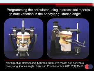 Programming the articulator using interocclusal records
to note variation in the condylar guidance angle
Nair CK et al. Relationship between protrusive record and horizontal
condylar guidance angle. Trends in Prosthodontics 2011;2(1):15-16.
 