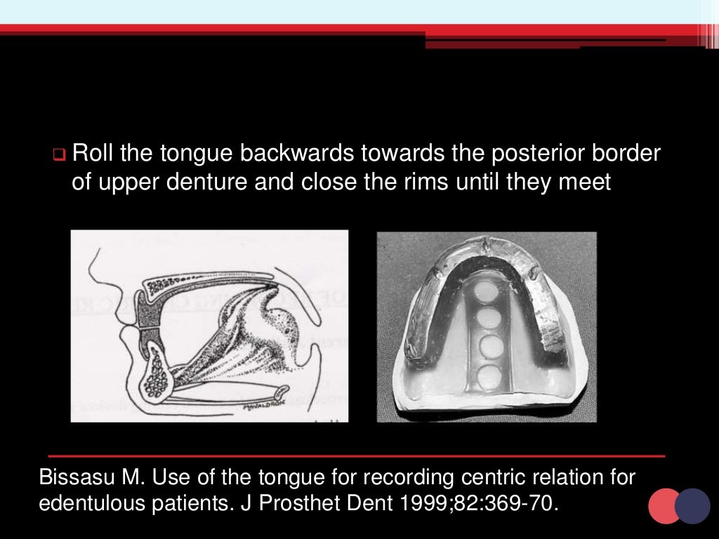 Horizontal jaw relation in complete denture