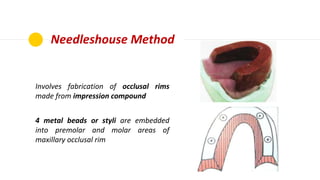 Needleshouse Method
Involves fabrication of occlusal rims
made from impression compound
4 metal beads or styli are embedde...