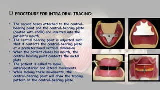 Presentation on horizontal jaw relation in prosthodontics | PPTX