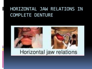 HORIZONTAL JAW RELATIONS IN
COMPLETE DENTURE
 