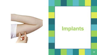 39
Implants
 